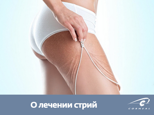 Лечение стрий