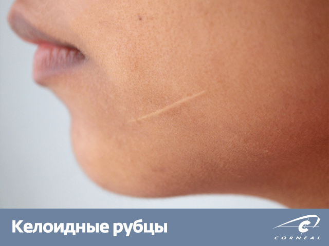 Келоидные рубцы