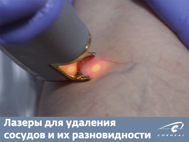Лазеры для удаления сосудов и их разновидности