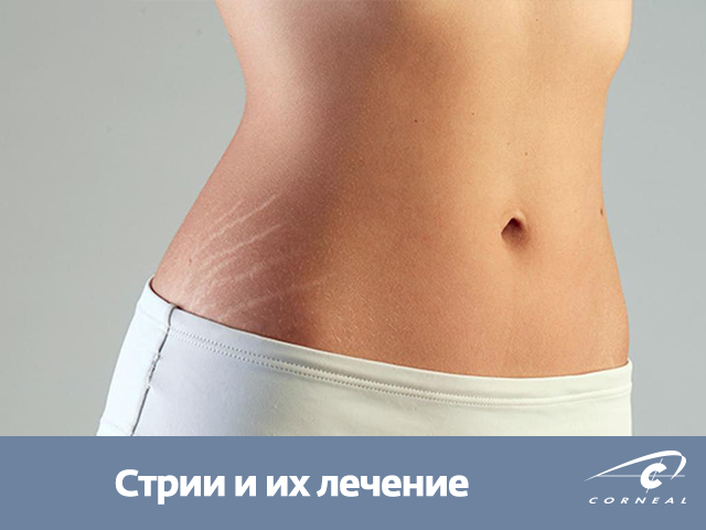 Стрии и их лечение