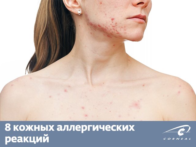 8 кожных аллергических реакций