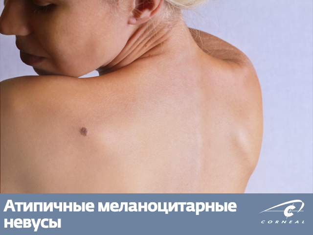 Атипичные меланоцитарные невусы