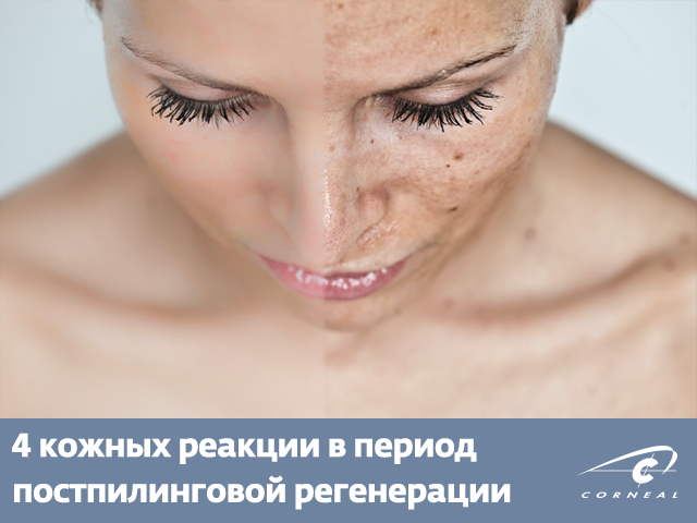 4 кожных реакции в период постпилинговой регенерации (2-6 недели)