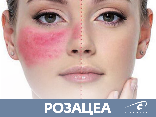 Розацеа